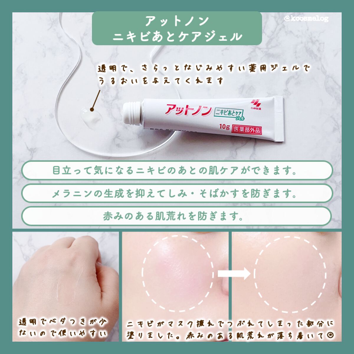 ニキビあとケアジェル/アットノン/その他スキンケアを使ったクチコミ（2枚目）