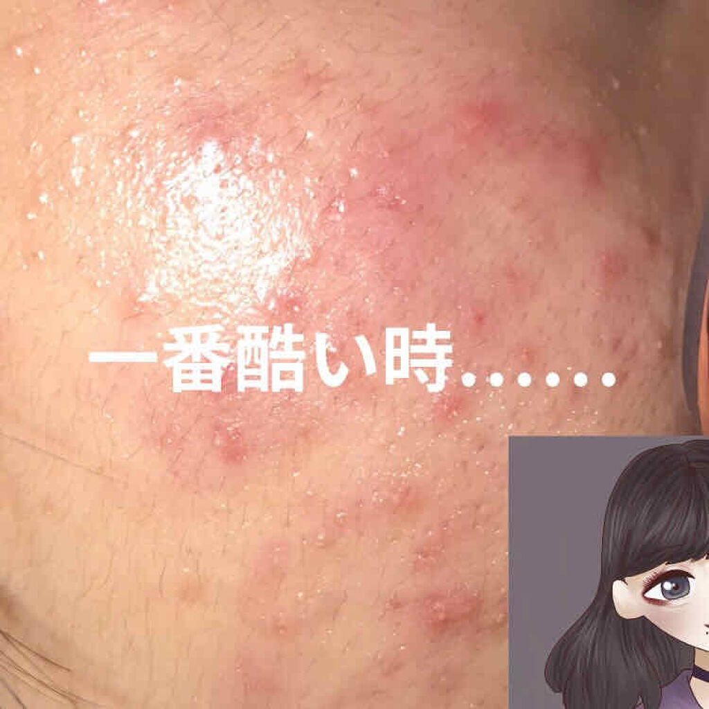 A アクネフォーム/NOV/洗顔フォームを使ったクチコミ（2枚目）