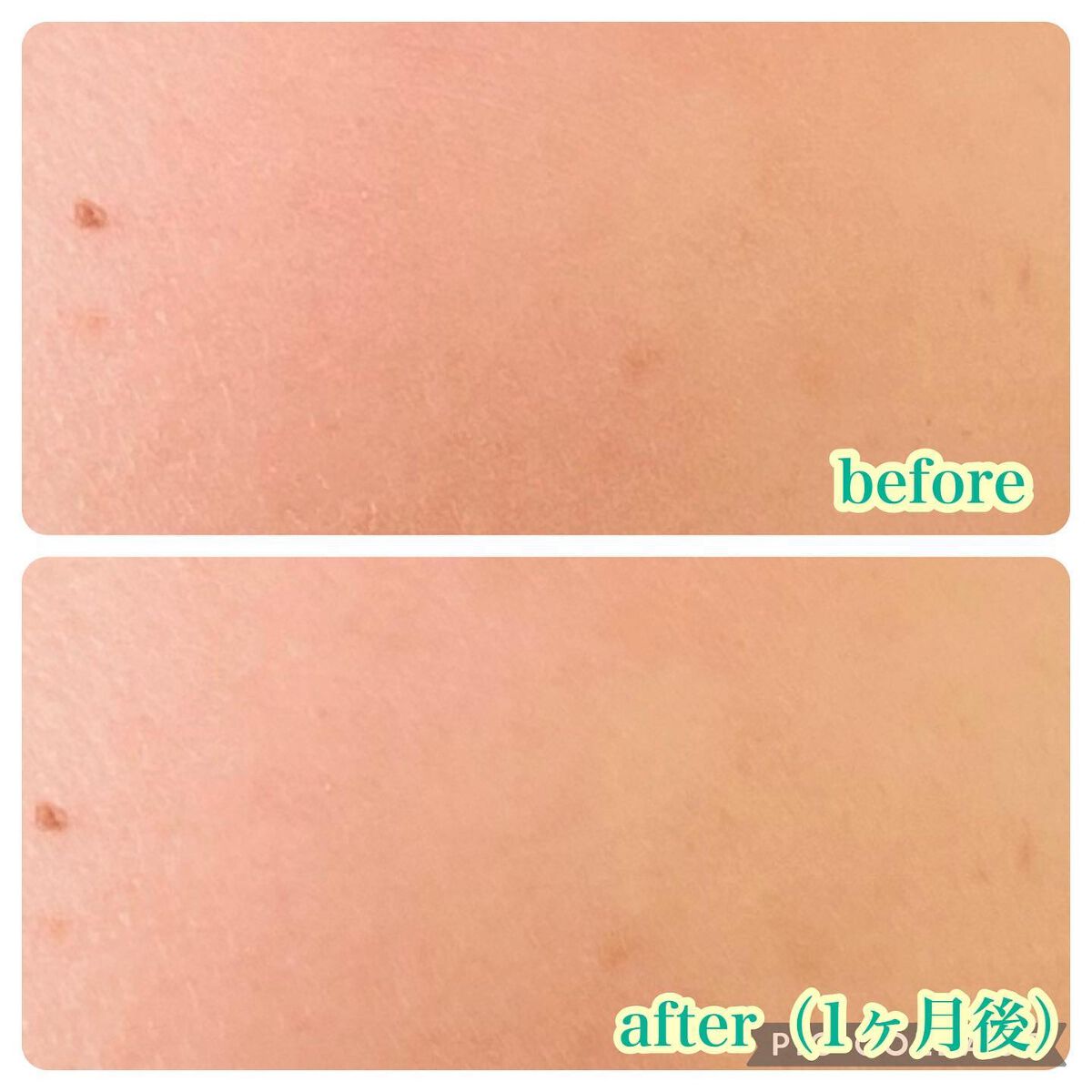 シカレチA クリーム0.05/VT/フェイスクリームを使ったクチコミ（3枚目）