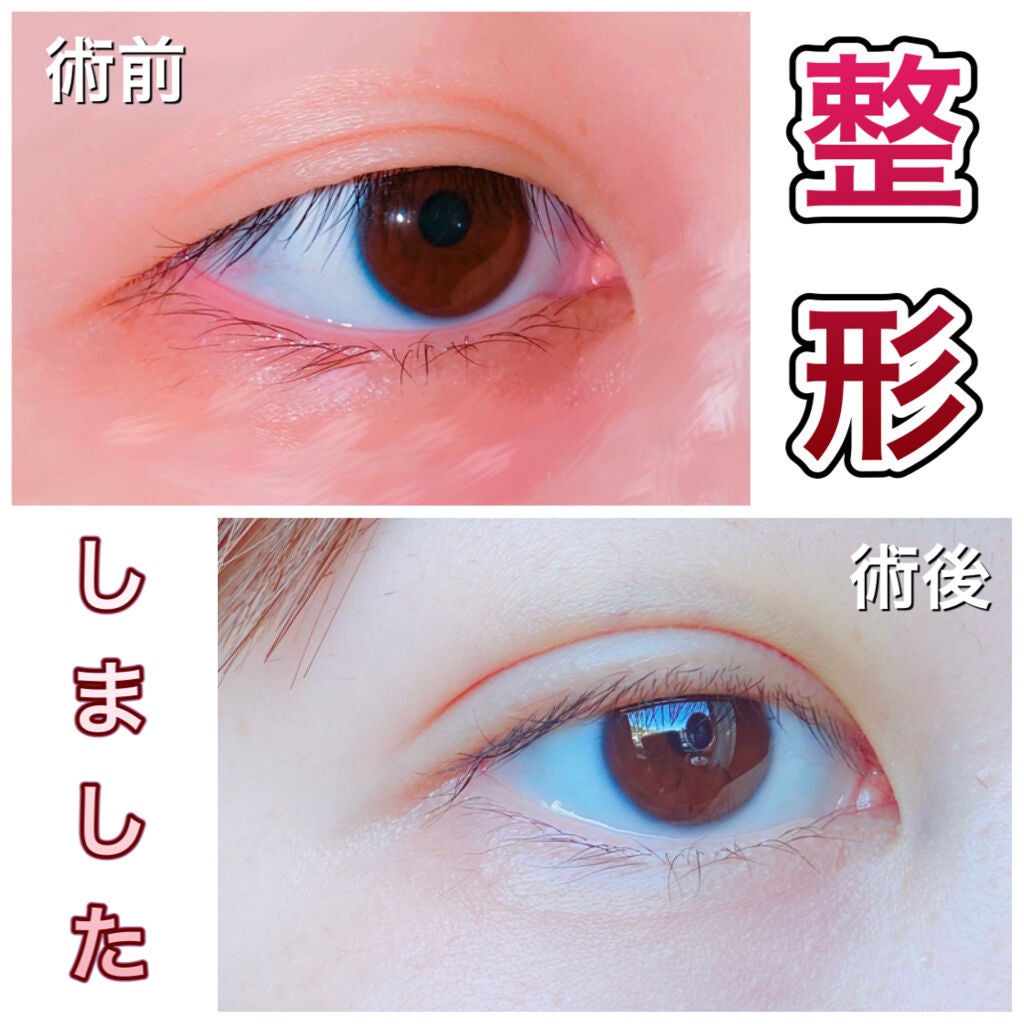 ゆず汰 on LIPS 「【埋没再施術】先週、二重整形してきました。2度目の埋没です‼️..」(1枚目)