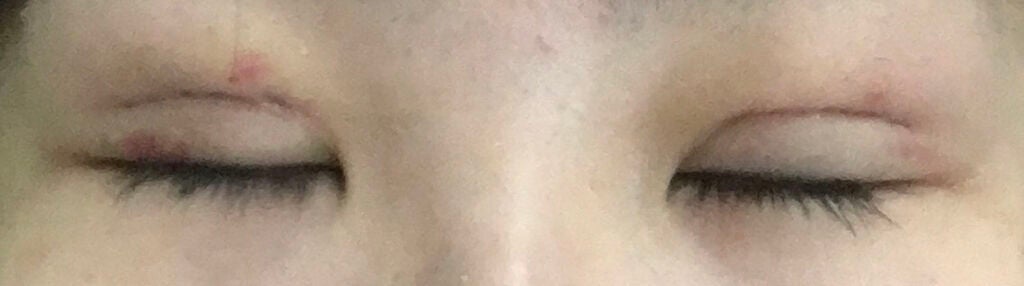 さにょん🍎 on LIPS 「④整形後2日目です。朝起きると安定の目やにが、、。ほんとにすご..」(2枚目)