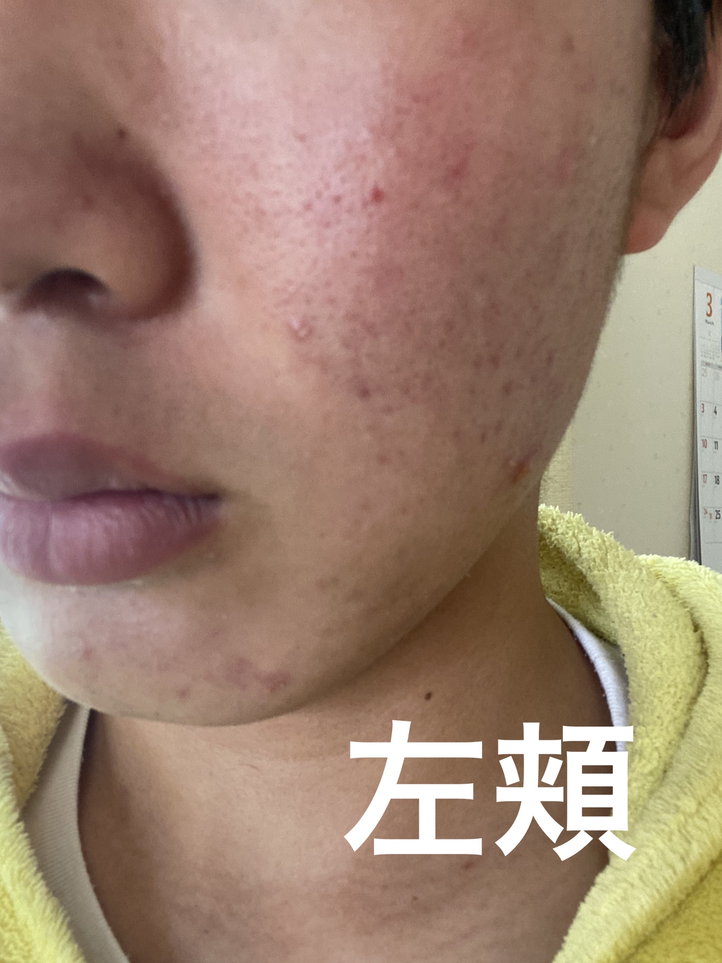 オルビス クリアフル ウォッシュのクチコミ「肌荒れ日記　1日目

今日から毎日できるかわからないけど自分の肌を投稿していきたいと思います。.....」（2枚目）