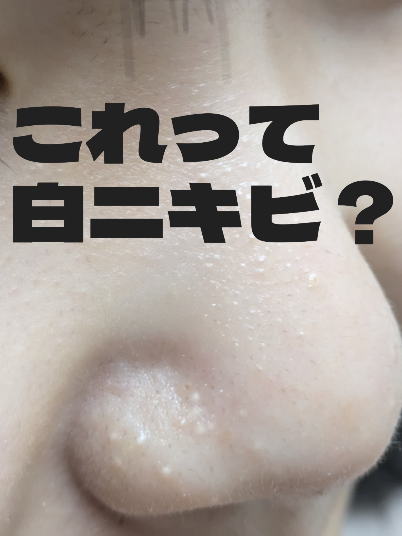 中学生娘の鼻のこれって、
いわゆる白ニキビでしょうか？
とりあえずはナチュリエ スキンコンディショナー Rハトムギ化粧水で保湿保湿保湿！
皮膚科に行ったほうがいいのかなぁ。
どなたかご存知でしたら教えていただきたいです。