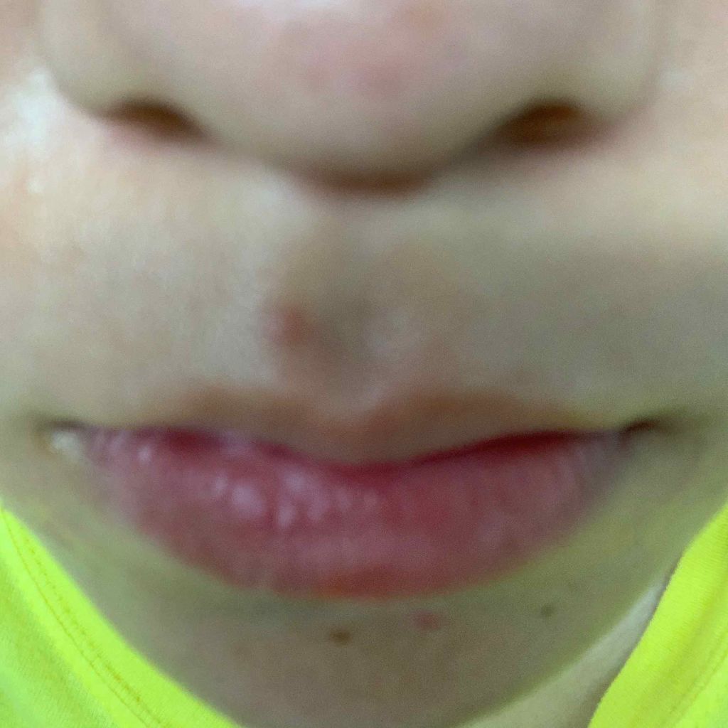 エピデュオゲル/マルホ株式会社/その他を使ったクチコミ（2枚目）