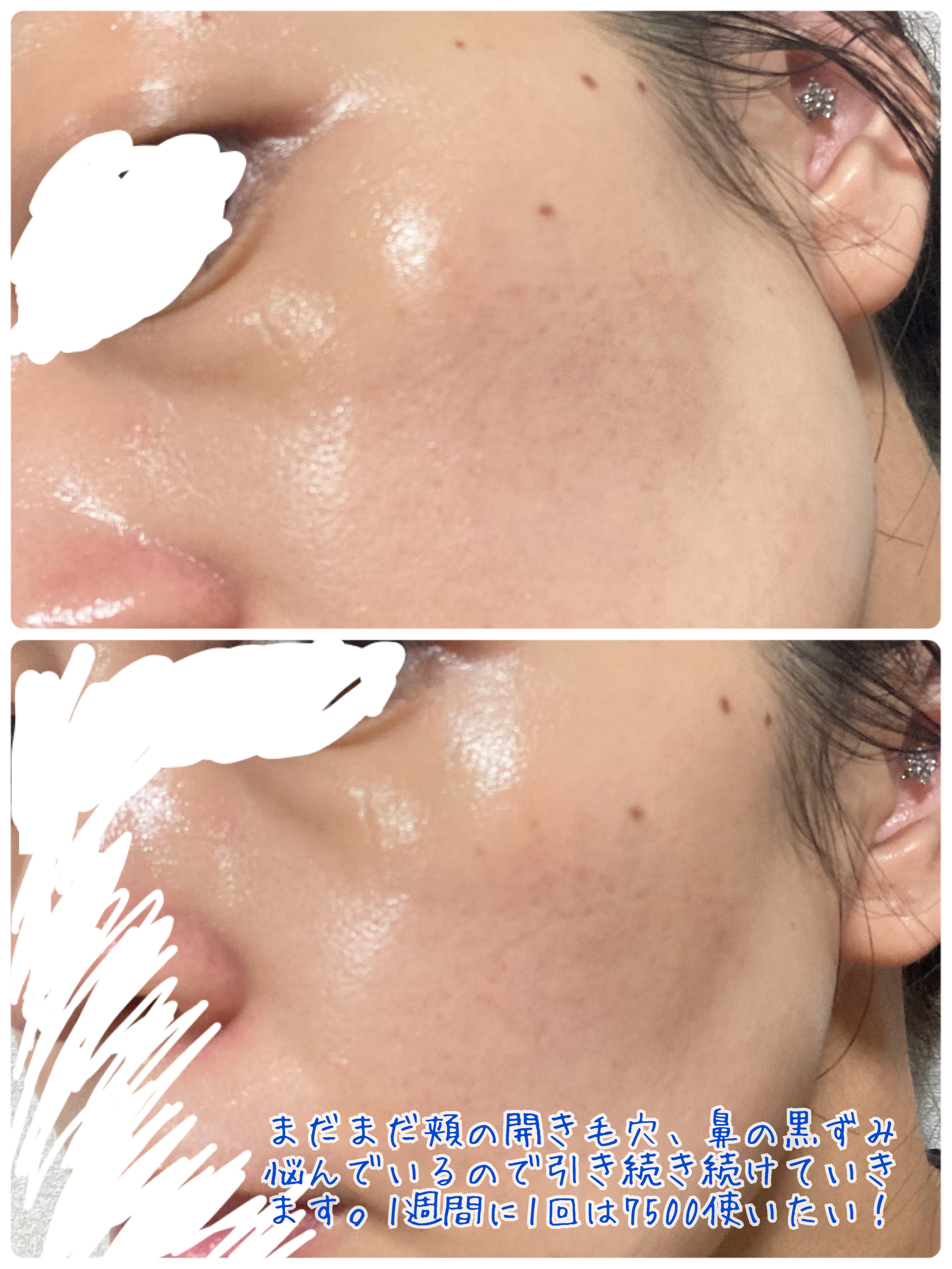 ゼロ1DAYエクソソームショット2000/MEDICUBE/美容液を使ったクチコミ（3枚目）