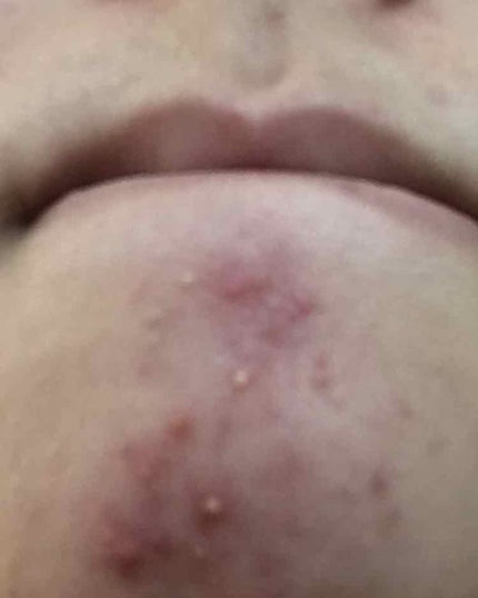 あめらむね on LIPS 「ニキビが全然減りません(T_T)私流のスキンケア朝、夜→ロゼッ..」(3枚目)