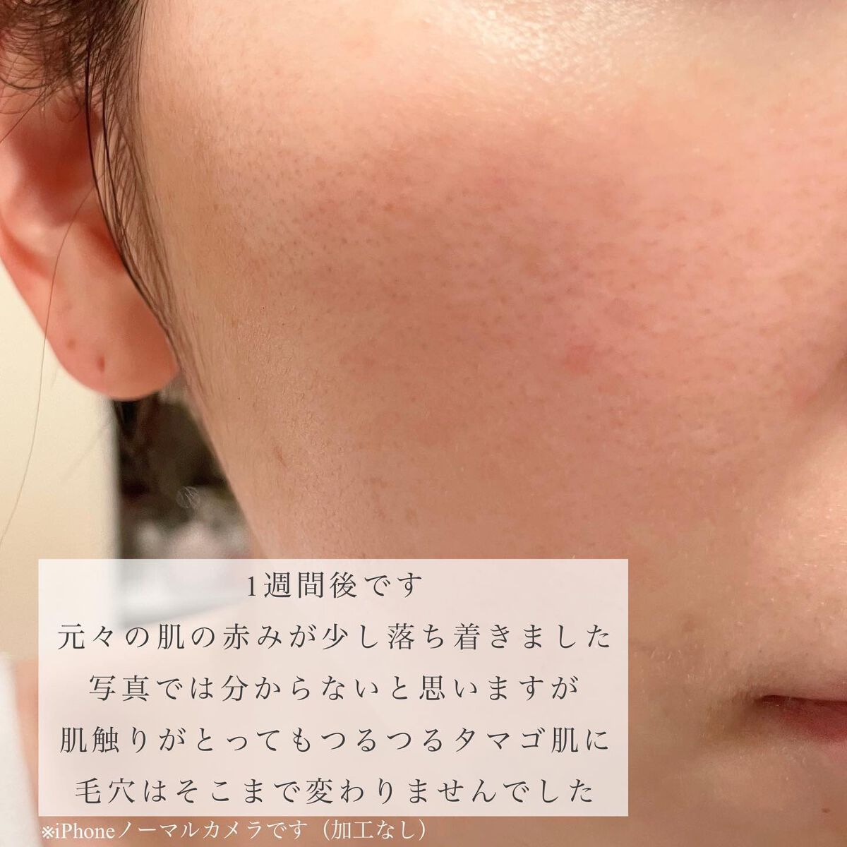 ダーマスキンピーリング/BQCELL/その他キットセットを使ったクチコミ(6枚目)