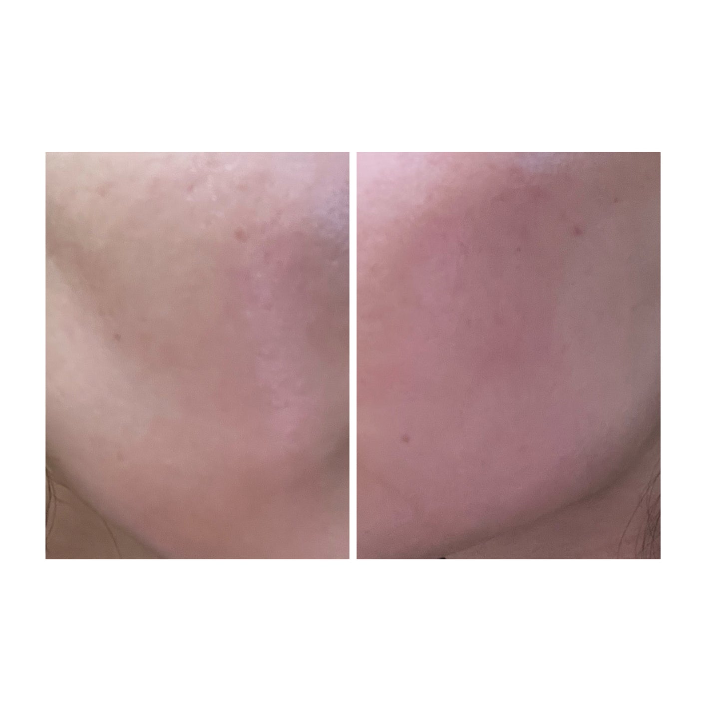 ぽむ on LIPS 「2023.9.13皮膚科に受診 エピデュオとヘパリン処方1枚目..」(4枚目)