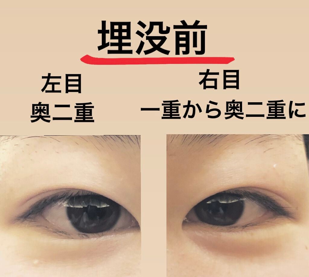 まる子 on LIPS 「こんにちはまる子です☺︎やっと、埋没してきました👏🏻もうずっと..」(2枚目)