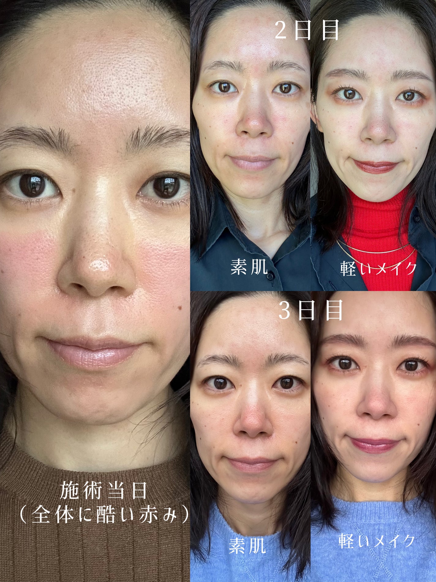 Miho on LIPS 「.#スキンケア好きな私だけど
何をやってもどう頑張っても
#鼻..」(5枚目)