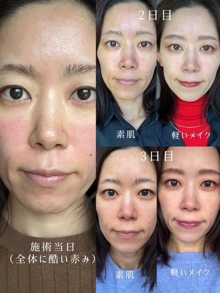 Miho on LIPS 「.#スキンケア好きな私だけど
何をやってもどう頑張っても
#鼻..」(5枚目)