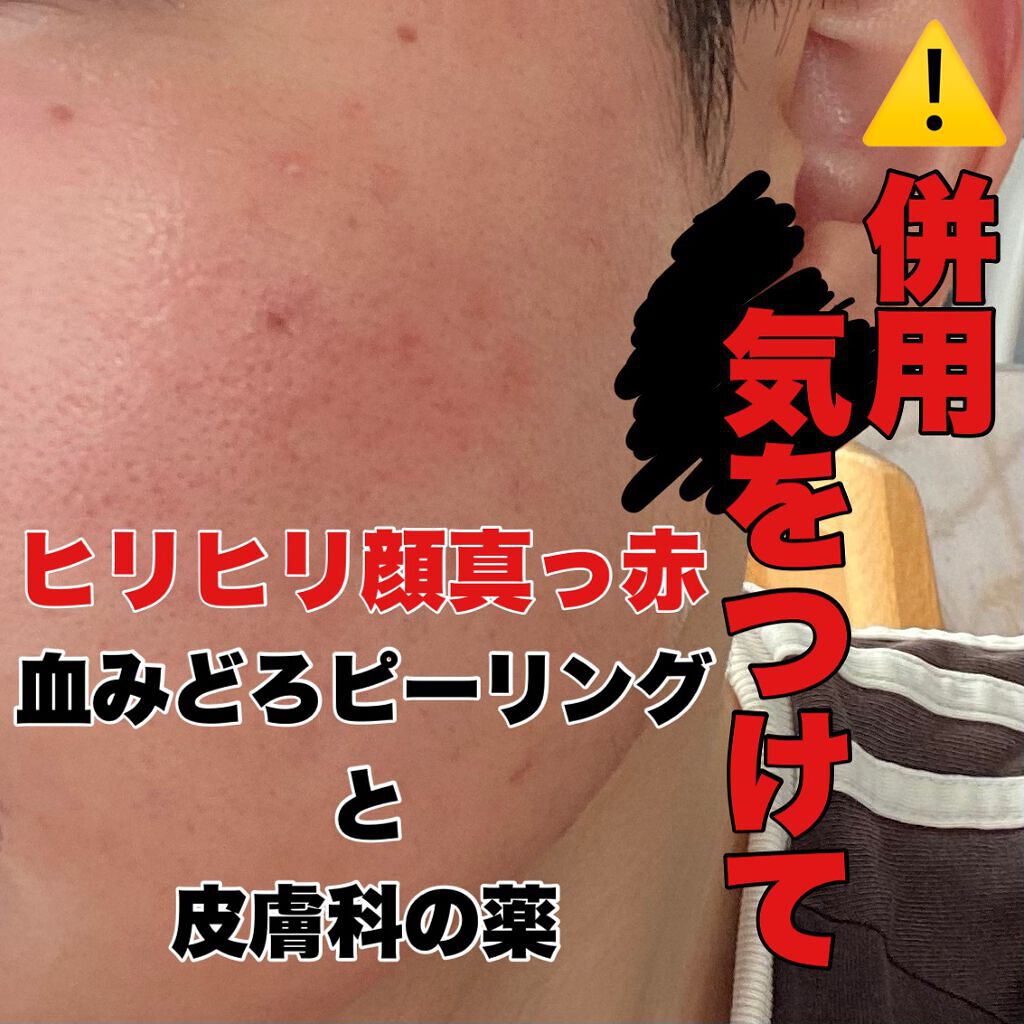AHA 30% + BHA 2% Peeling Solution/The Ordinary/ピーリングを使ったクチコミ（1枚目）