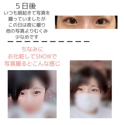 二重整形/その他を使ったクチコミ(3枚目)