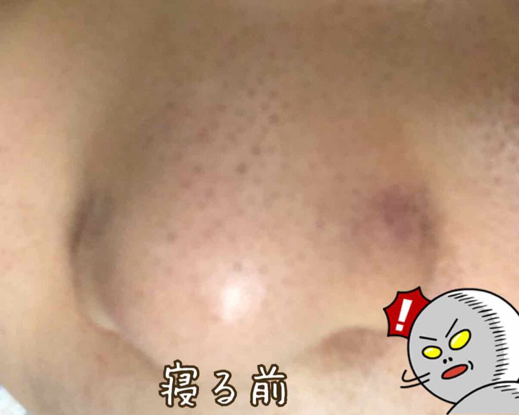 ツルリ 皮脂吸い出し 部分用パック ガスール&レッドパワー/ツルリ/洗い流すパック・マスクを使ったクチコミ(3枚目)