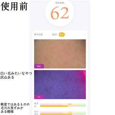 MEDICUBE ゼロ毛穴1DAYセラムのクチコミ「本当に毛穴が綺麗になった！
鼻の毛穴改善、2週間後チャレンジ！！
メディキューブのゼロ毛穴シリ.....」（2枚目）