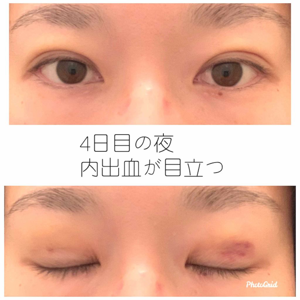 二重整形/その他を使ったクチコミ（3枚目）