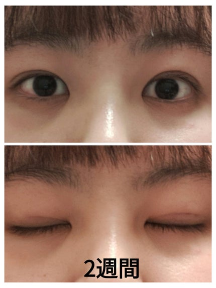 kaira on LIPS 「二重整形しちゃいました🤭今までも何度か二重の投稿をさせてもらっ..」(9枚目)