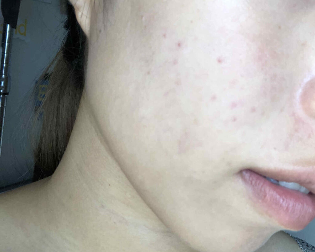 クリアトライアルセット M（しっとりタイプ）/オルビス/トライアルキットを使ったクチコミ（2枚目）