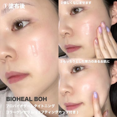 お肌にハリ・弾力が欲しい人!!
手軽にできるリフトアップアイテムを紹介❣️

【BIOHEAL BOH】
プロバイオダームタイトニング
コラーゲンセラム
(リフティングカップ付き)

オリーブヤングの自社ブランドである
BIOHEAL BOHのセラムが最強過ぎて、
紹介せずにはいられない🔥💓

美白ケアや毛穴ケアなどに
気をつけている女性は多いと思います😊

プラスでハリや弾力などの
たるみケアもしっかりして欲しい！！
ということでおすすめなのがこのセラム💓

オリーブヤングが特許を取った最強の成分
「タンタンバイオーム」がお肌にハリと弾力を
しっかり与えてくれる✨

ハリ・弾力系のアイテムって
重ためのテクスチャーが多いと思うんだけど、
このセラムはとっても軽いから朝夜場面を問わず使える💓

この最強のセラムをよくお肌になじませた後に、
いよいよ付属のリフティングカップの出番です✨

①リフティングカップを軽くおしながら、
お肌に密着させます。

②お肌の内側から外側に向かって
引き上げてスライドさせます。

③頬だけでなく、
目元や額にも紹介するのがポイントです。

セラムとリフティングカップを
一緒に使うことで、効果大💓

ピンっと張ったハリのあるお肌に！
ハリ・弾力ケア効果だけでなく、
小顔やたるみケアにもアプローチ✨

参考になった方はいいねや保存で教えてください💓

#オリーブヤング #バイオヒールボ #BIOHEALBOH #スキンケアルーティン #ハリケア #弾力ケア #タンタンバイオーム #韓国コスメ 
の画像 その2