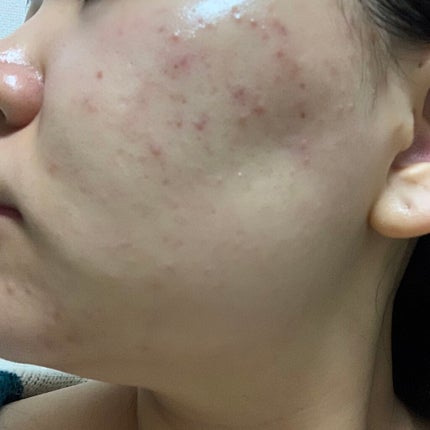 ティーツリーケア ソリューション エッセンシャルマスクEX/MEDIHEAL/シートマスク・パックを使ったクチコミ(3枚目)