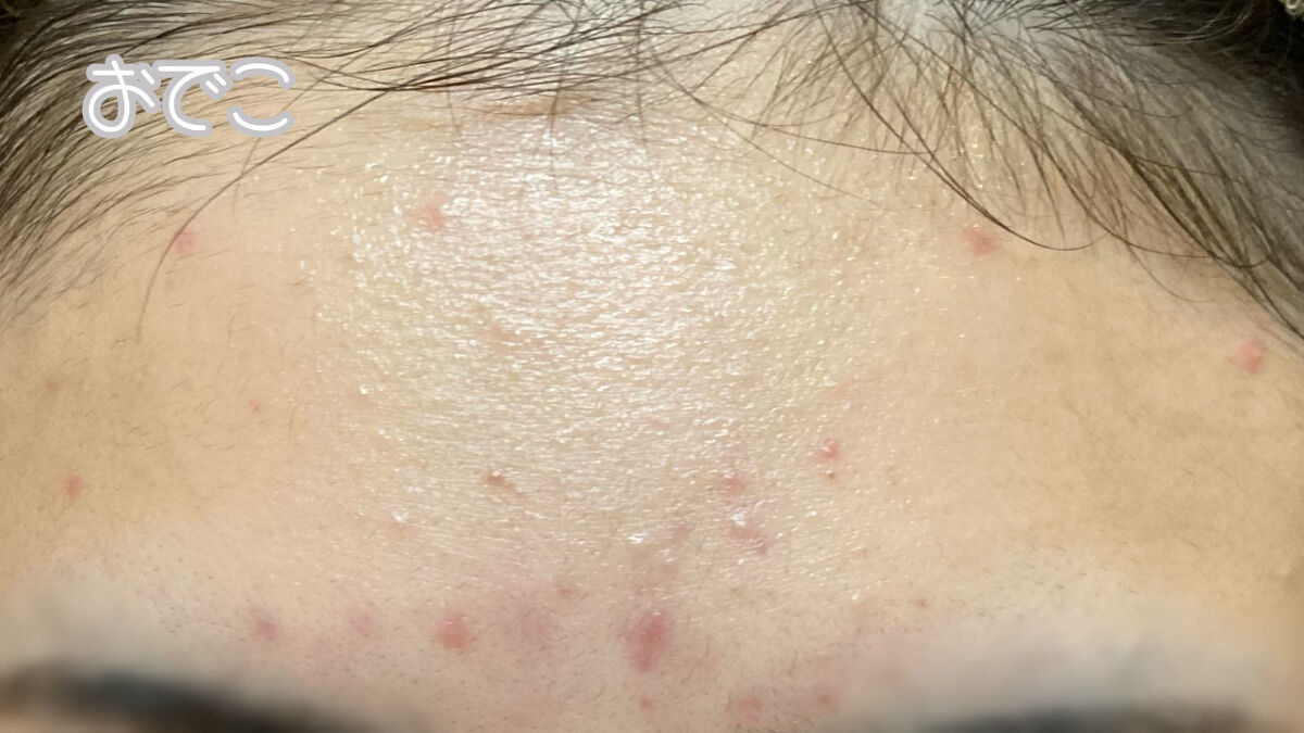 薬用しみ対策 美白化粧水 しっとりタイプ/メラノCC/化粧水を使ったクチコミ（2枚目）