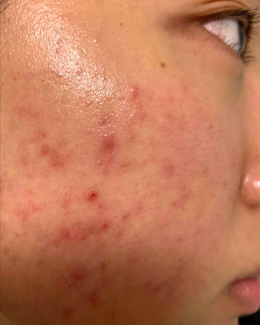 万年ニキビ肌 on LIPS 「5/7前回から3日後〜〜やっぱりじっくり熟成させて出来たニキビ..」(2枚目)