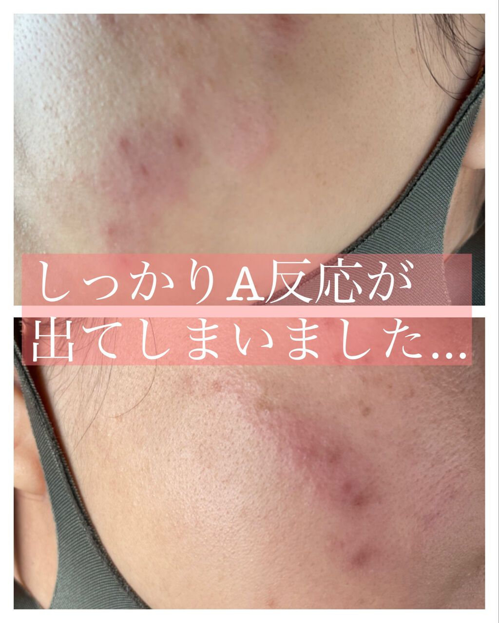 シミシェルジュ リュバンブランの口コミ シミシェルジュ 純ハイドロキノン4 Ht By くるみ 混合肌 Lips