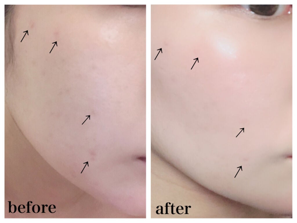 ピンクティーツリーカバークッション/APLIN/クッションファンデーションを使ったクチコミ(3枚目)