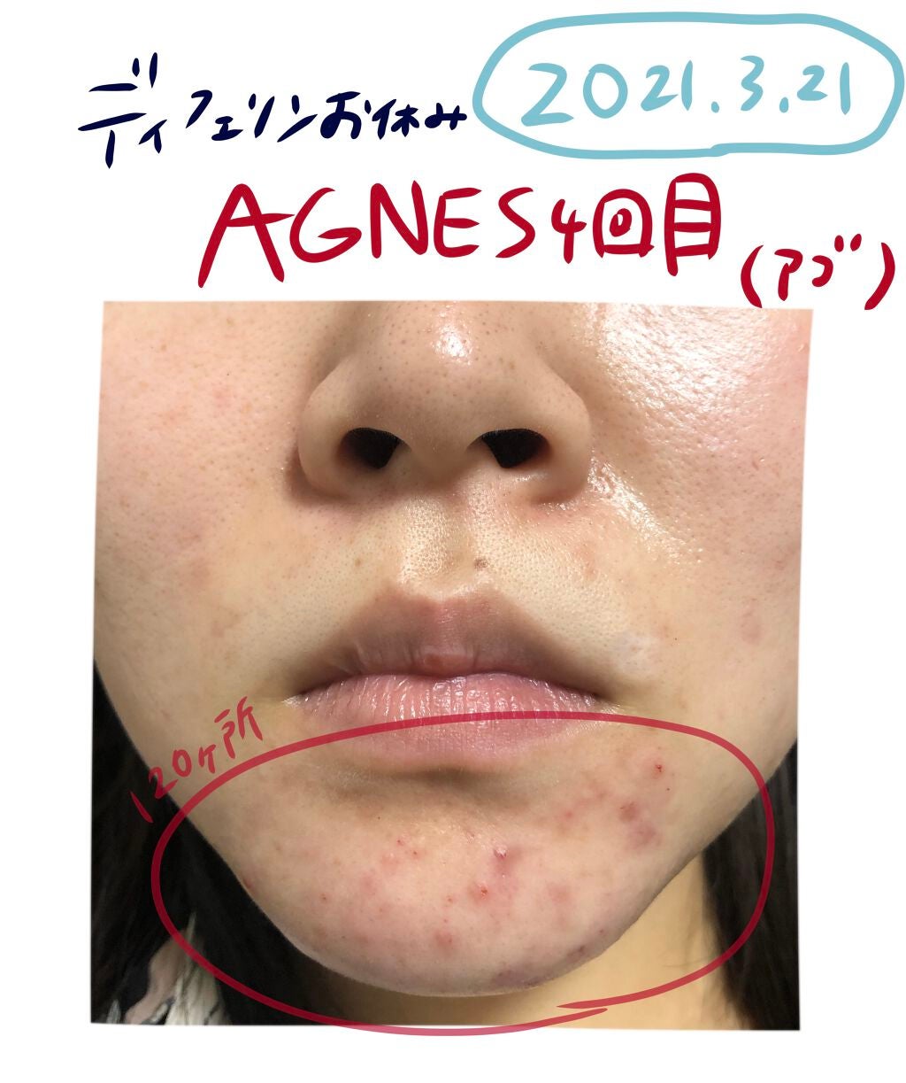 まるこ on LIPS 「※2枚目閲覧注意ニキビログ〜!&アグネスレポ🖋ニキビログニキビ..」(2枚目)