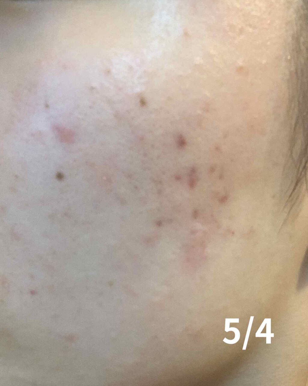 ミノン アミノモイスト 薬用アクネケア ローション/ミノン/化粧水を使ったクチコミ（2枚目）