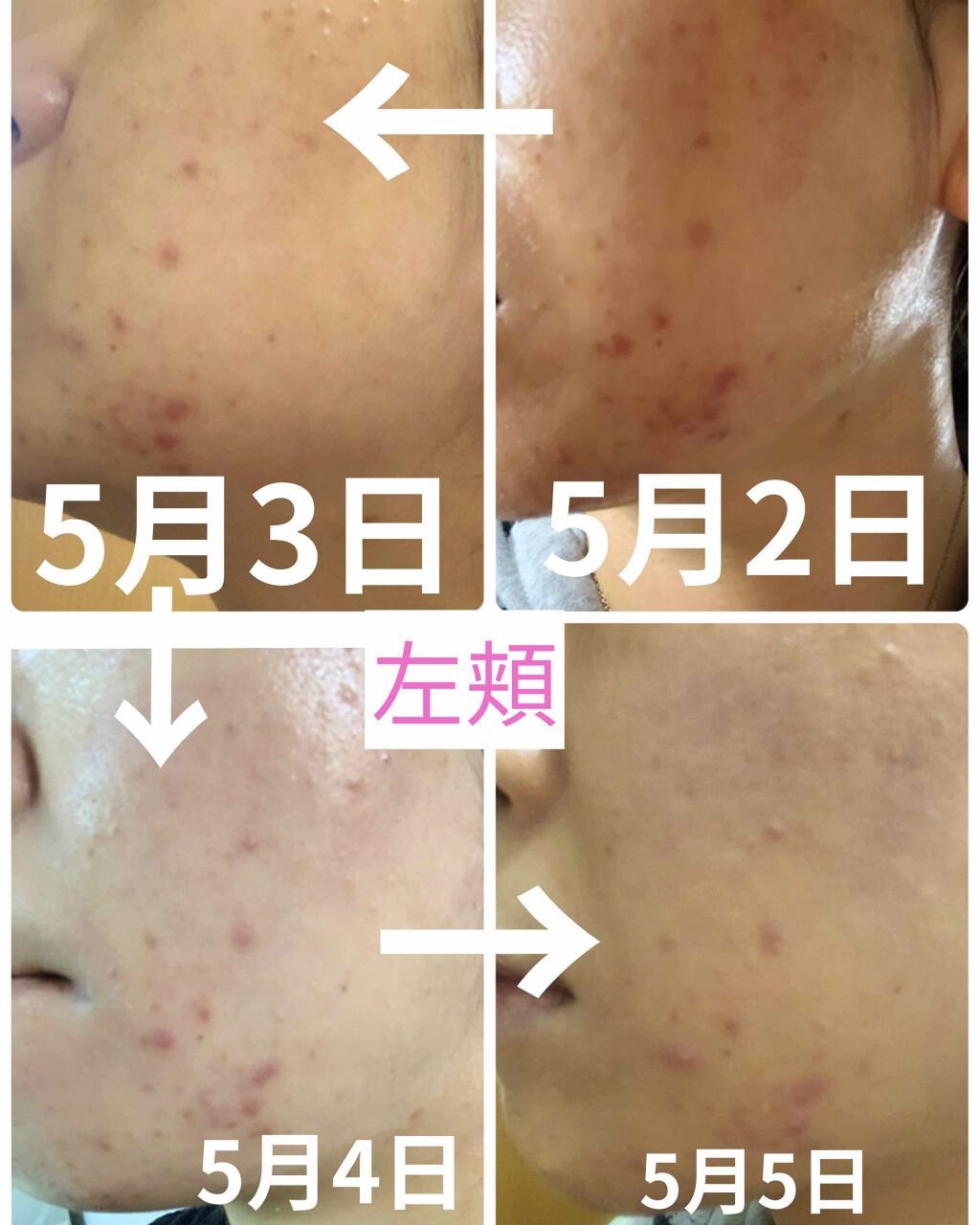 Hika1* on LIPS 「エピデュオ経過報告‼️⚠️汚肌写真注意5月1日からエピデュオゲ..」(2枚目)