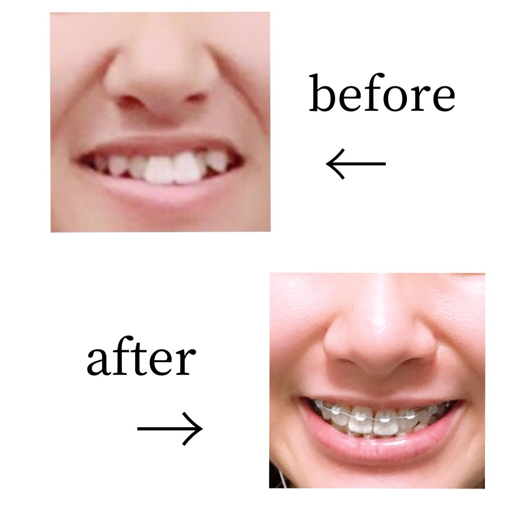 クリニカアドバンテージ ハミガキ/クリニカ/歯磨き粉を使ったクチコミ（2枚目）