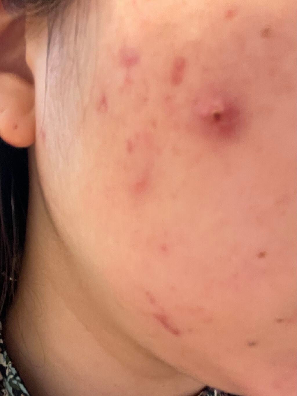 pink_perfume_5ccp on LIPS 「メイク後です。炎症ニキビ6個。今日は毎週行っている皮膚科です。..」(1枚目)