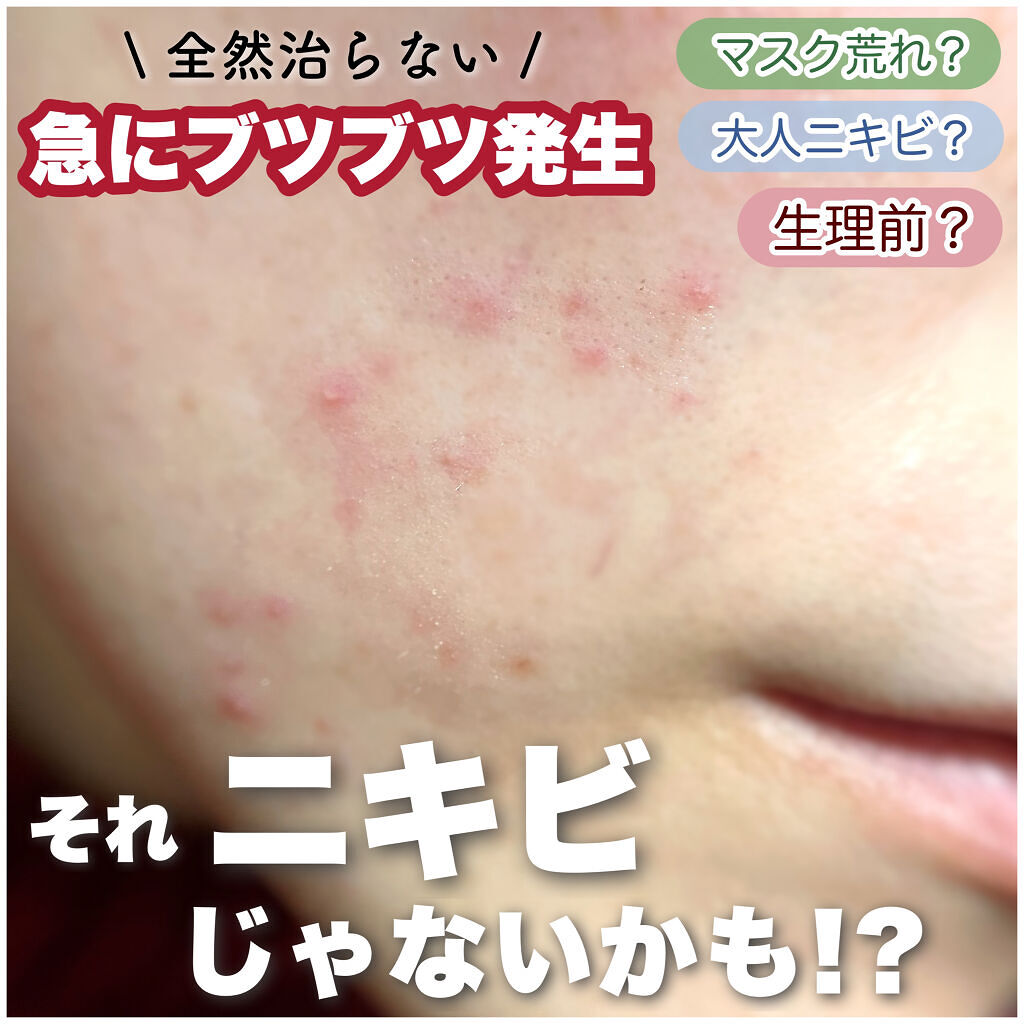 プリスクリードd 医薬品 Ihadaを使った口コミ 2日で実感 ニキビだと思っていた謎のブツ By りちゃ𓆗いいね返し 乾燥肌 代前半 Lips