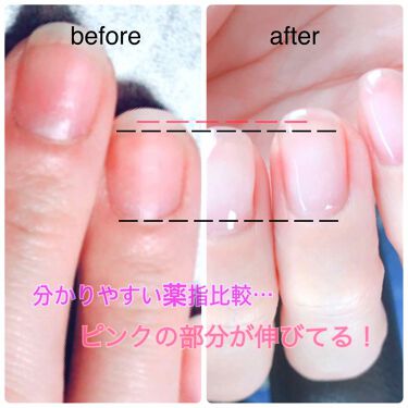 ネイルエンビー O P Iを使った口コミ 私は中学生まで爪の噛み癖がありました 高校 By Mint 乾燥肌 代後半 Lips