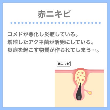 紗々🌸フォロバ100(投稿ある方) on LIPS 「ニキビ撲滅するにはまずニキビの特徴を知れということでニキビとは..」（6枚目）