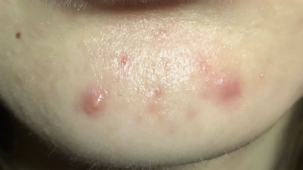 ACケア/ACROPASS/その他スキンケアを使ったクチコミ（2枚目）