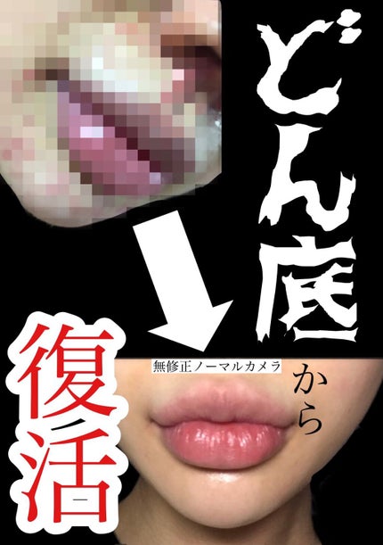 清上防風湯 セイジョウボウフウトウ(医薬品)/ツムラ/その他を使ったクチコミ(1枚目)