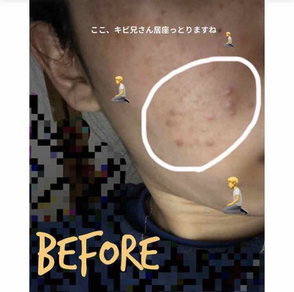 クロマイ-N軟膏(医薬品)/第一三共ヘルスケア/その他を使ったクチコミ(2枚目)