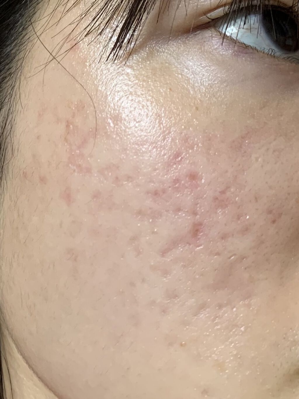 オードムーゲ 薬用ローション（ふきとり化粧水）/オードムーゲ/拭き取り化粧水を使ったクチコミ（3枚目）