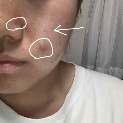 りちゃ on LIPS 「初投稿です!!!!親や妹は全然ニキビなくスベスベ肌なのに、何故..」(1枚目)