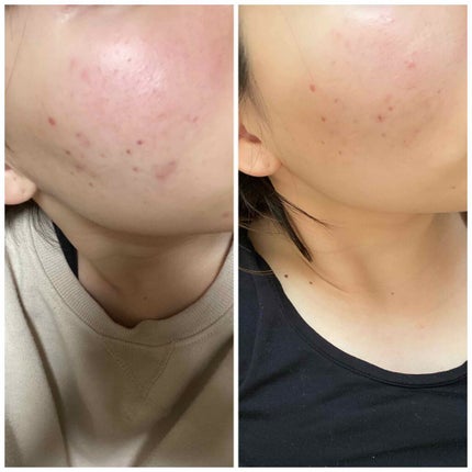 薬用 しみ 集中対策 美容液/メラノCC/美容液を使ったクチコミ(3枚目)