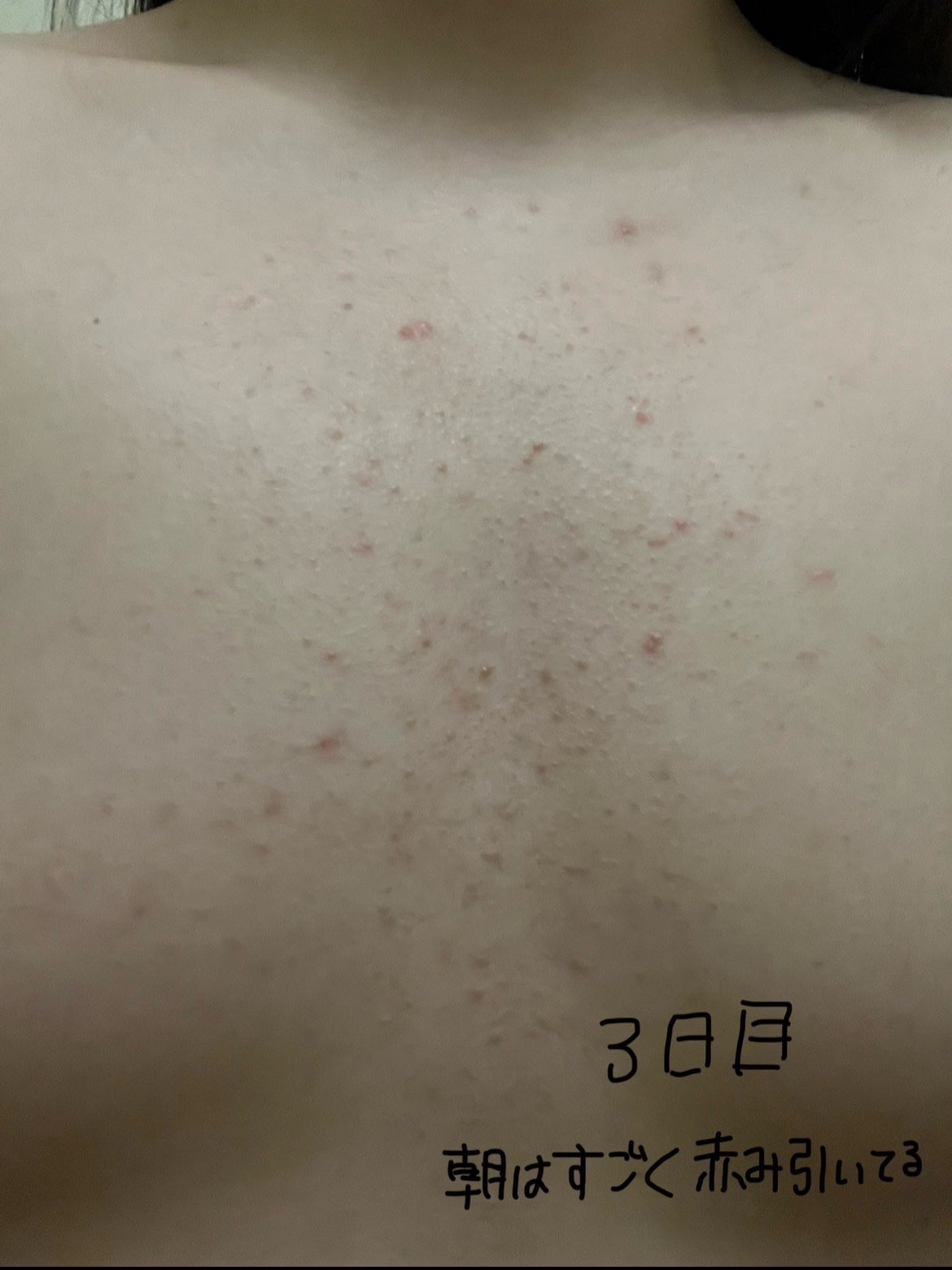 ニキビを防ぐ薬用石鹸 ForBack/ペリカン石鹸/ボディ石鹸を使ったクチコミ(4枚目)