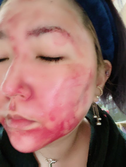 AHA 30% + BHA 2% Peeling Solution/The Ordinary/ピーリングを使ったクチコミ(2枚目)