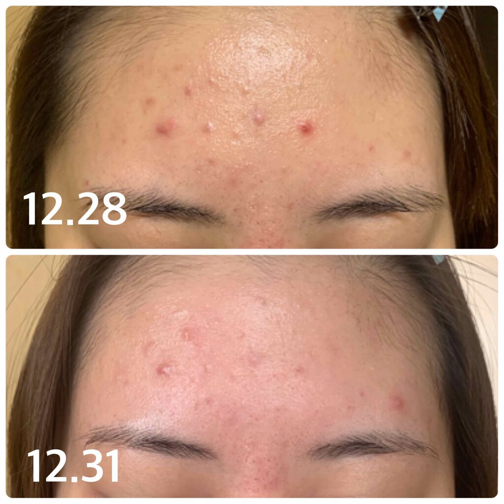 血の池軟膏(医薬品)/血の池地獄/その他を使ったクチコミ（1枚目）