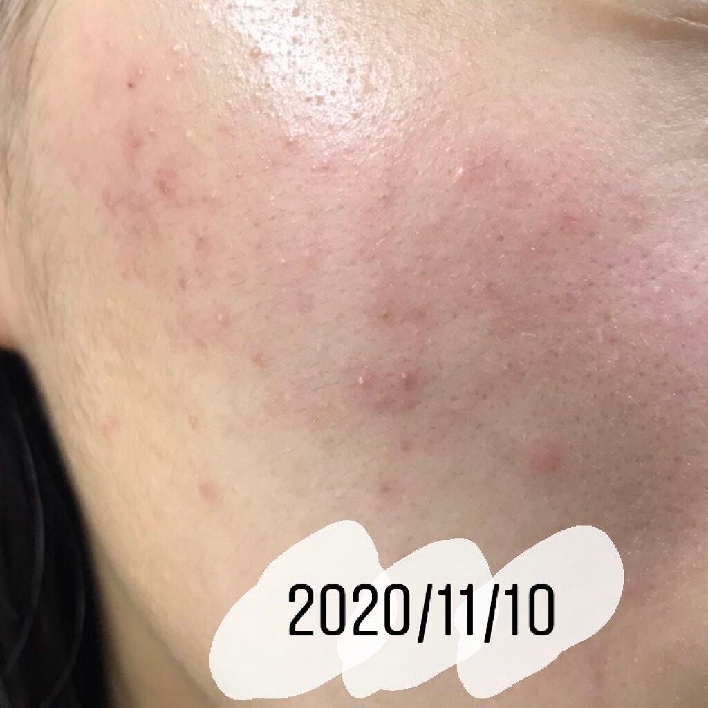 タラコソース on LIPS 「ニキビ日記3日目#ニキビ日記#ニキビ#綺麗になるまで..」(2枚目)