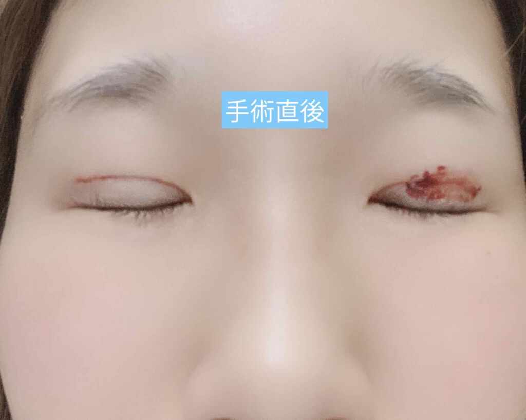 海悠 on LIPS 「二重整形してきました。ずっと一重で悩んでて、お母さんやおばあち..」(2枚目)