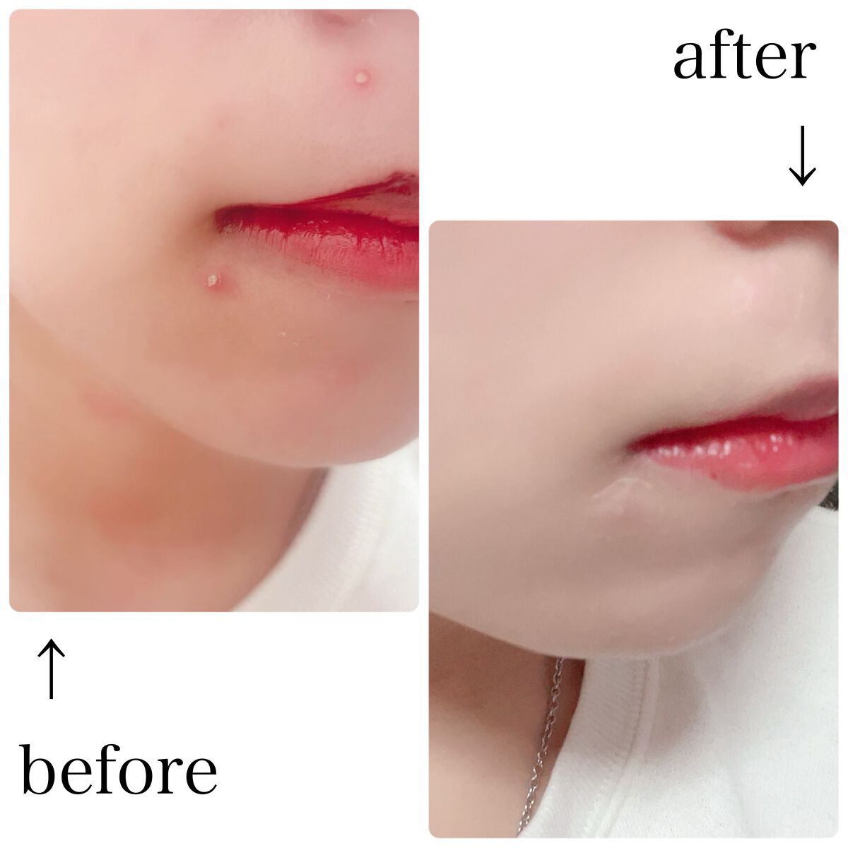 CICAティーツリークリアパッチ+/Angelab/にきびパッチを使ったクチコミ(4枚目)