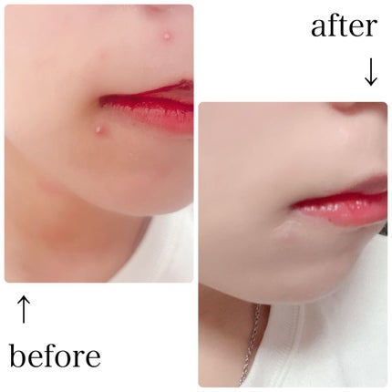 CICAティーツリークリアパッチ+/Angelab/にきびパッチを使ったクチコミ(4枚目)