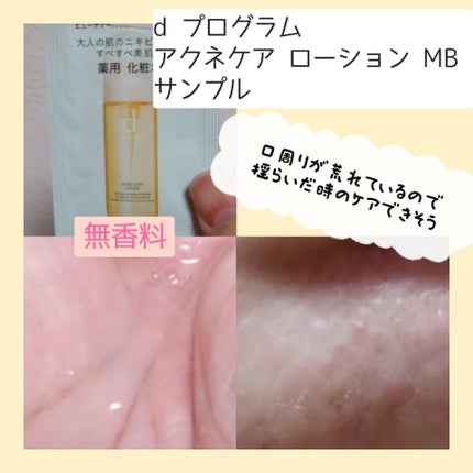 アクネケア ローション MB/d プログラム/化粧水を使ったクチコミ(2枚目)